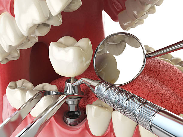 Best Lost Filling or Crown Replacement in Tellico Village, TN